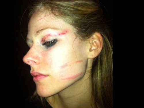 avril lavigne beat up. Here's Avril Lavigne's Face After Getting Beat Up [+] enlarge